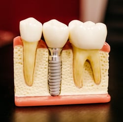 AAID LifeSmiles - Dental Implant - Example-1-1-1