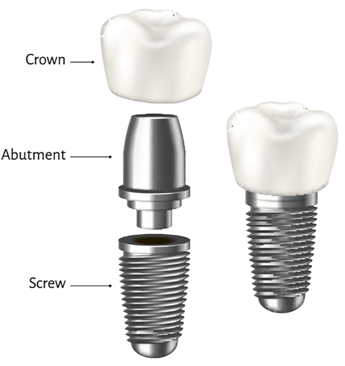 How Strong are Dental Implants?