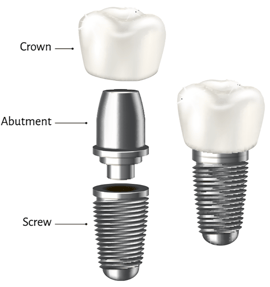 Dental implant diagram of screw
