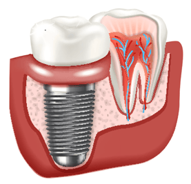 dental implant diagram in gum