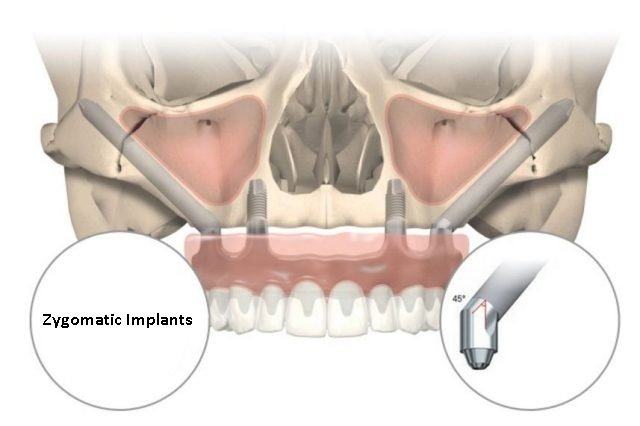 Dr. Ramsey Amin DDS - Zygomatic Implants