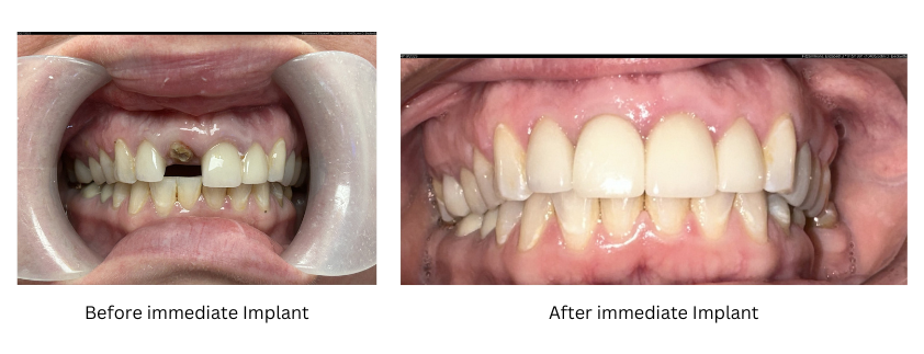 Before and after image of immediate implants