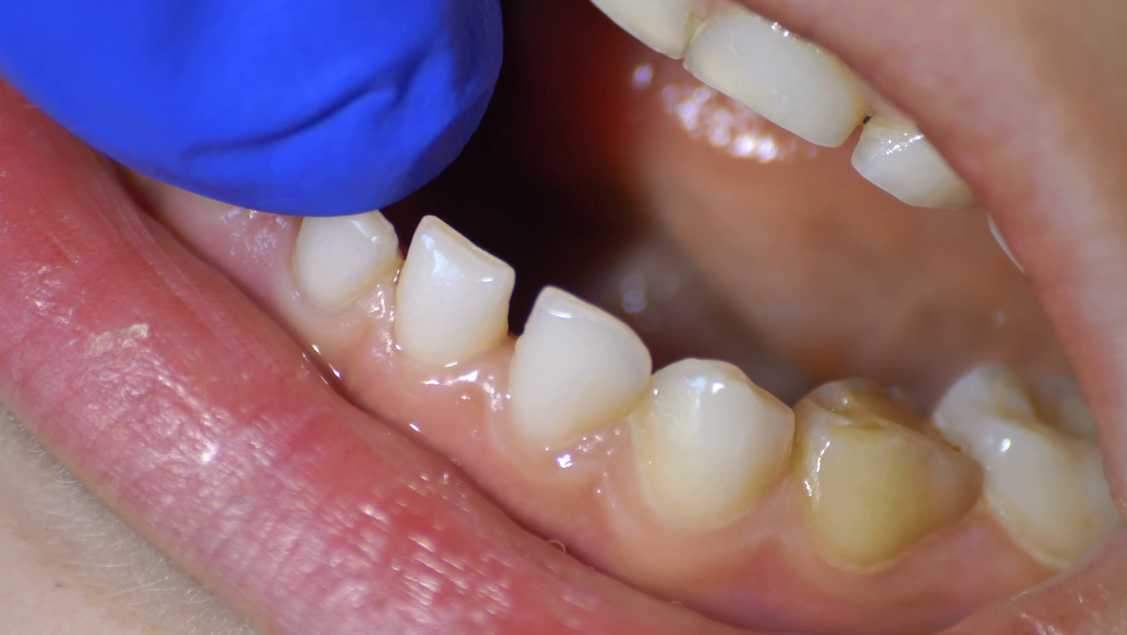 dentist hand examining a loose tooth