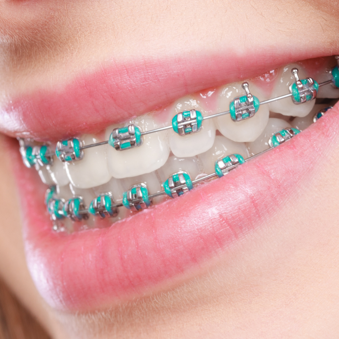 A smiling mouth with braces